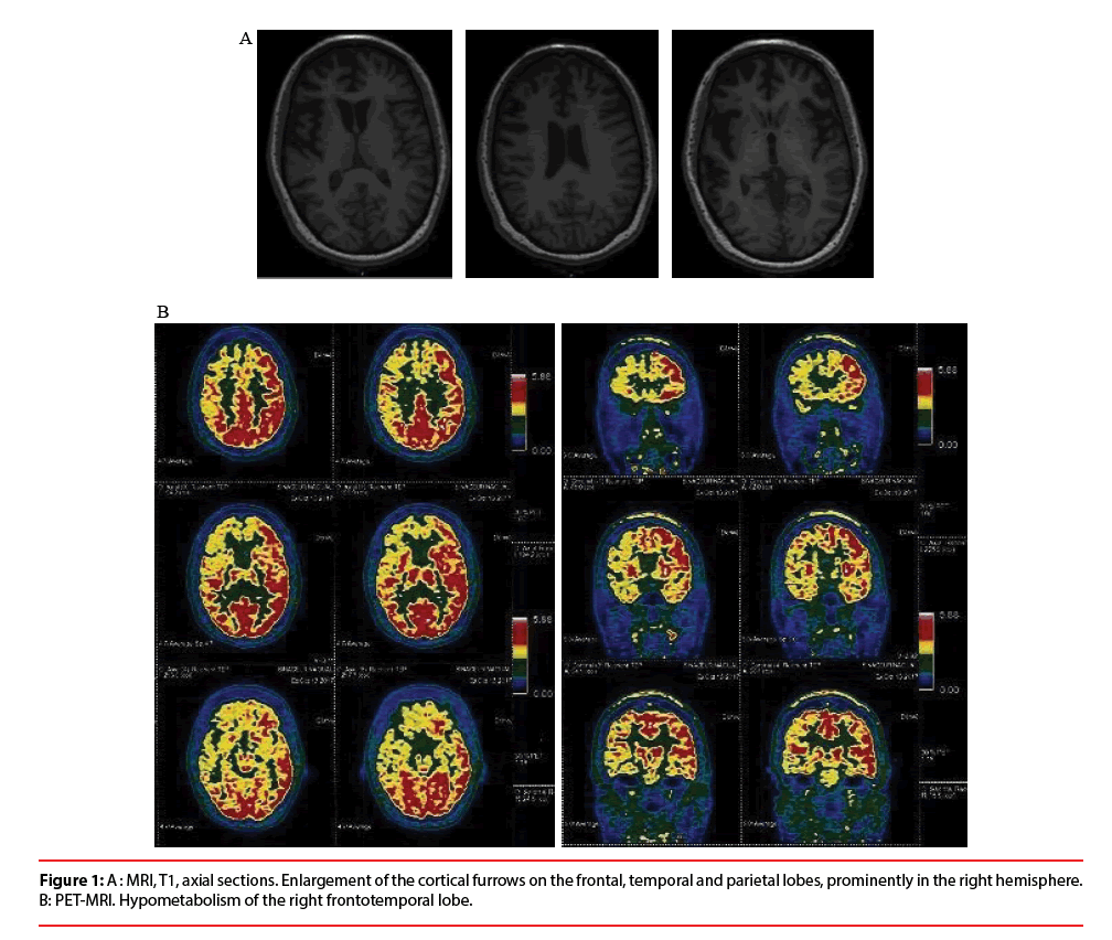 jneuropsychiatry-frontotemporal