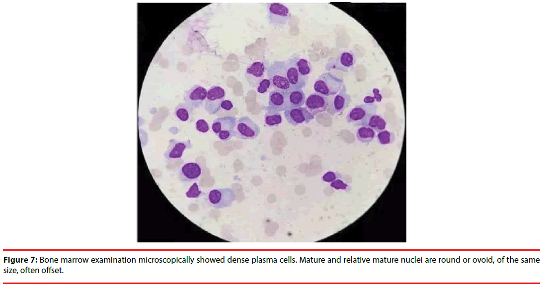 neuropsychiatry-Bone-marrow