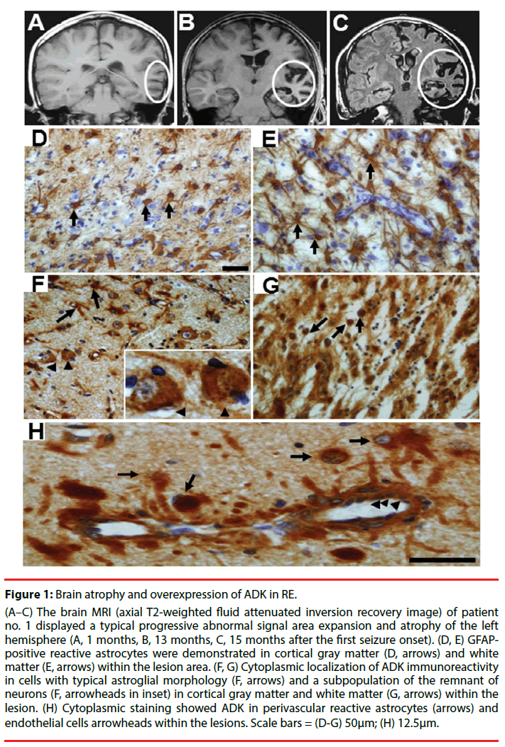 neuropsychiatry-Brain-atrophy