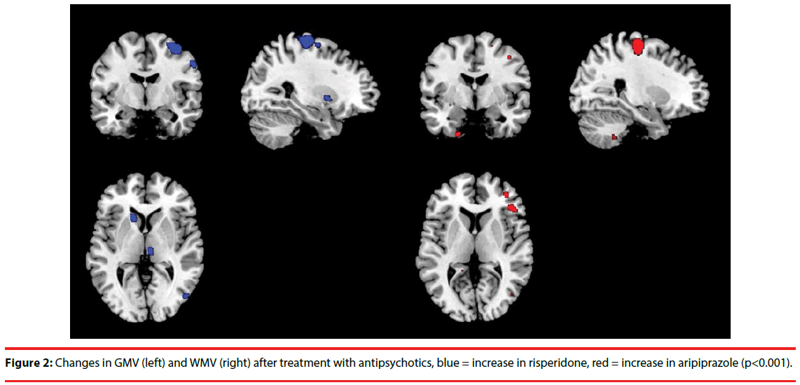 neuropsychiatry-Changes-GMV