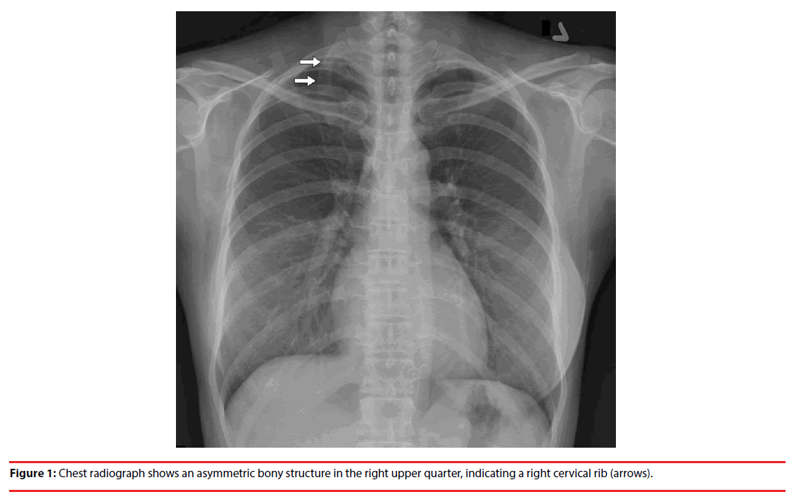 neuropsychiatry-Chest-radiograph