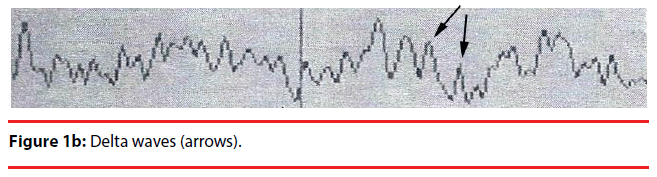 neuropsychiatry-Delta-waves