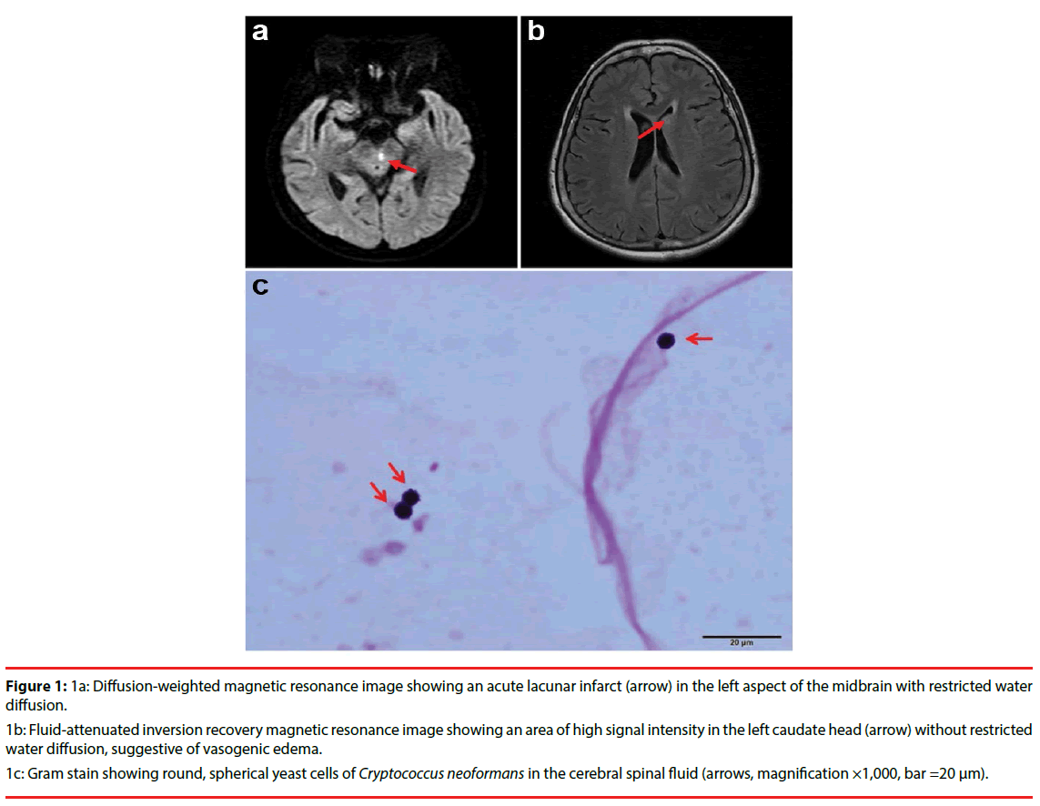 neuropsychiatry-Diffusion-weighted