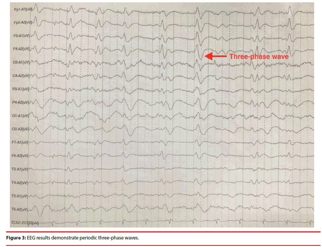 neuropsychiatry-EEG-results