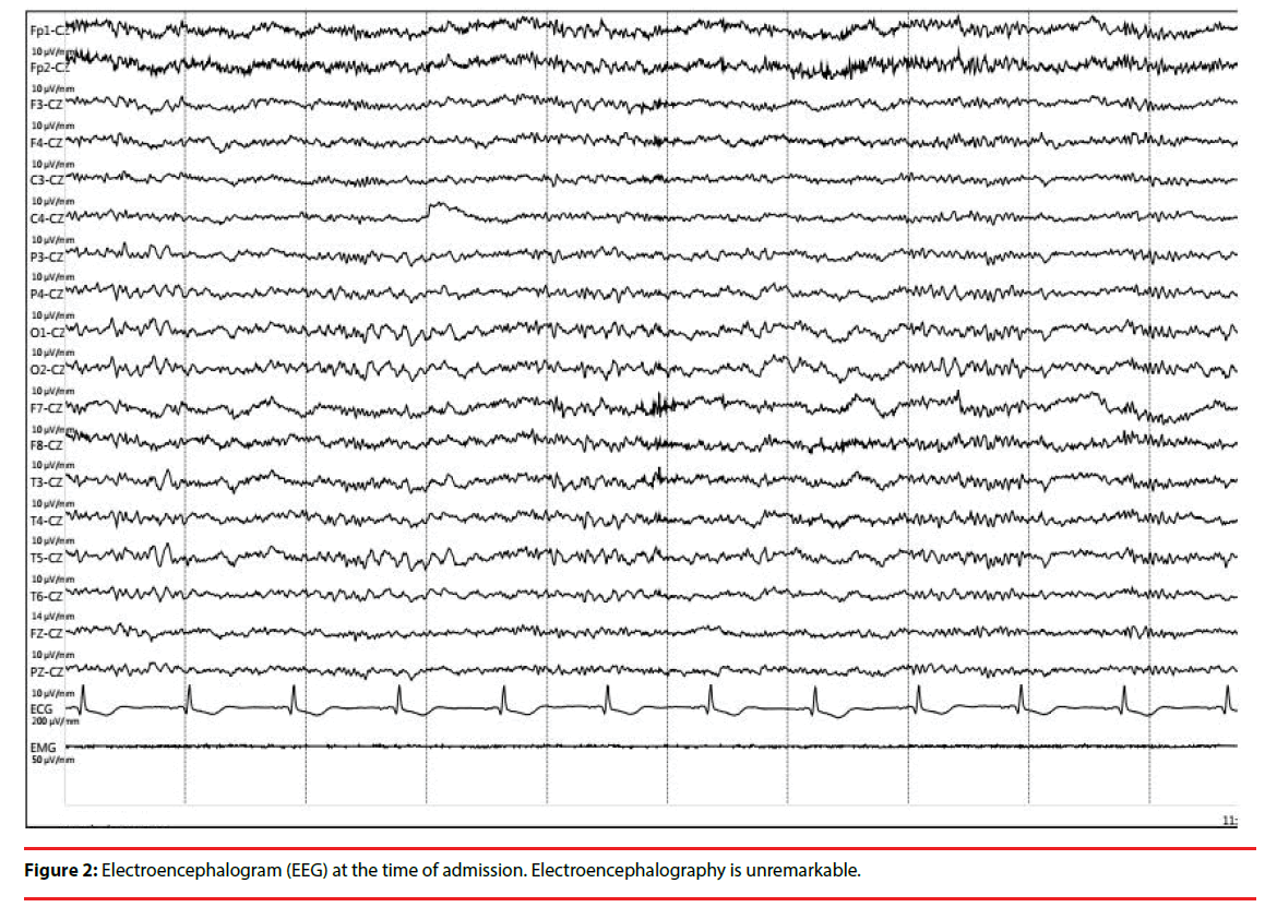 neuropsychiatry-Electroencephalogram-time