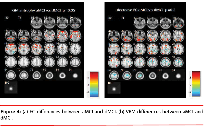 neuropsychiatry-FC-differences-between-aMCI