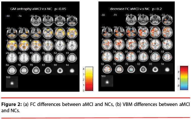 neuropsychiatry-FC-differences-between-aMCI-NCs