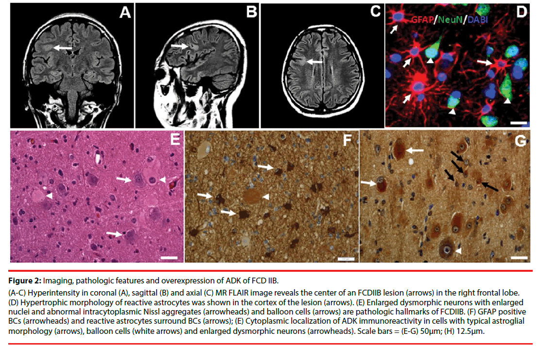 neuropsychiatry-FLAIR-image