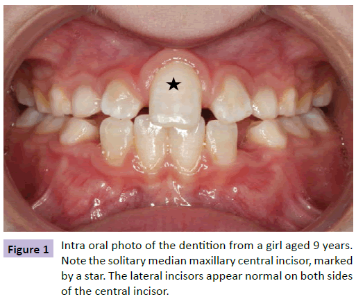 neuropsychiatry-Intra-oral-photo-dentition
