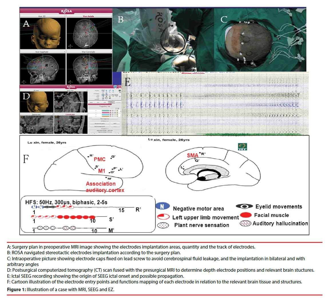 neuropsychiatry-MRI-SEEG