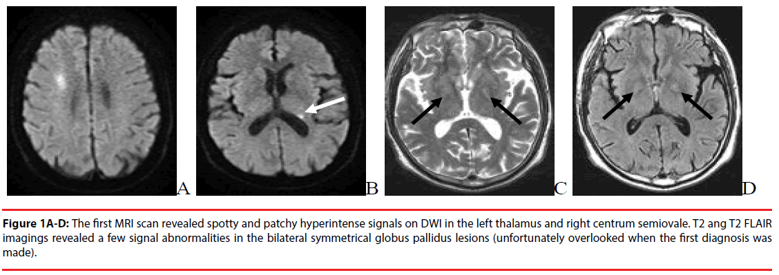 neuropsychiatry-MRI-scan