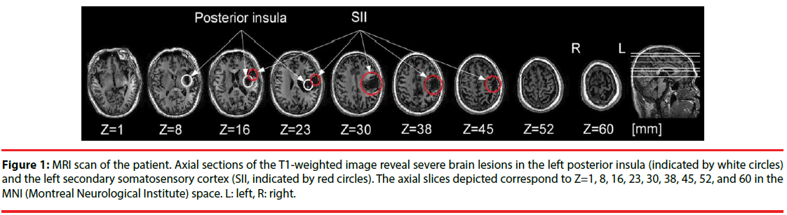 neuropsychiatry-MRI-scan