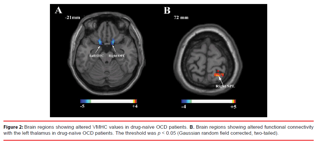 neuropsychiatry-OCD-patients