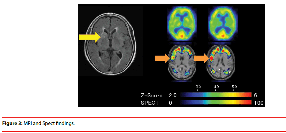 neuropsychiatry-Spect-findings