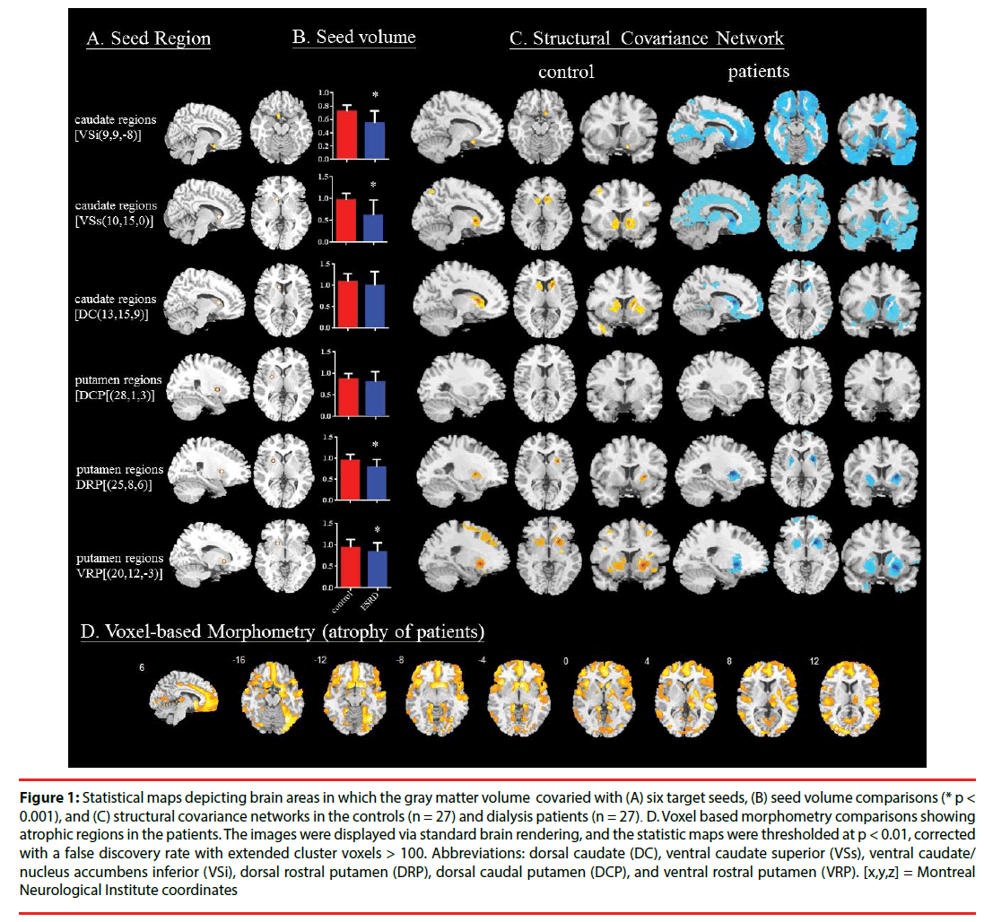 neuropsychiatry-Statistical-maps