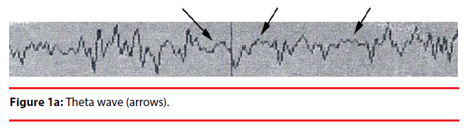 neuropsychiatry-Theta-wave