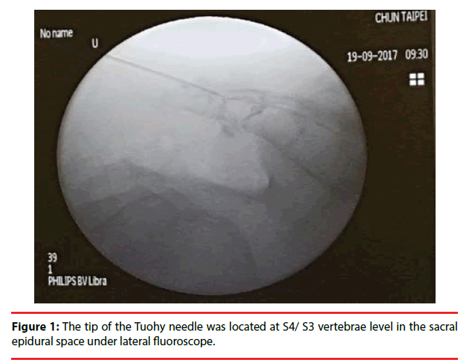 neuropsychiatry-Tuohy-needle