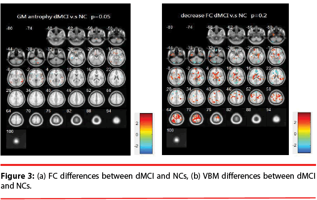 neuropsychiatry-VBM-differences-between-dMCI