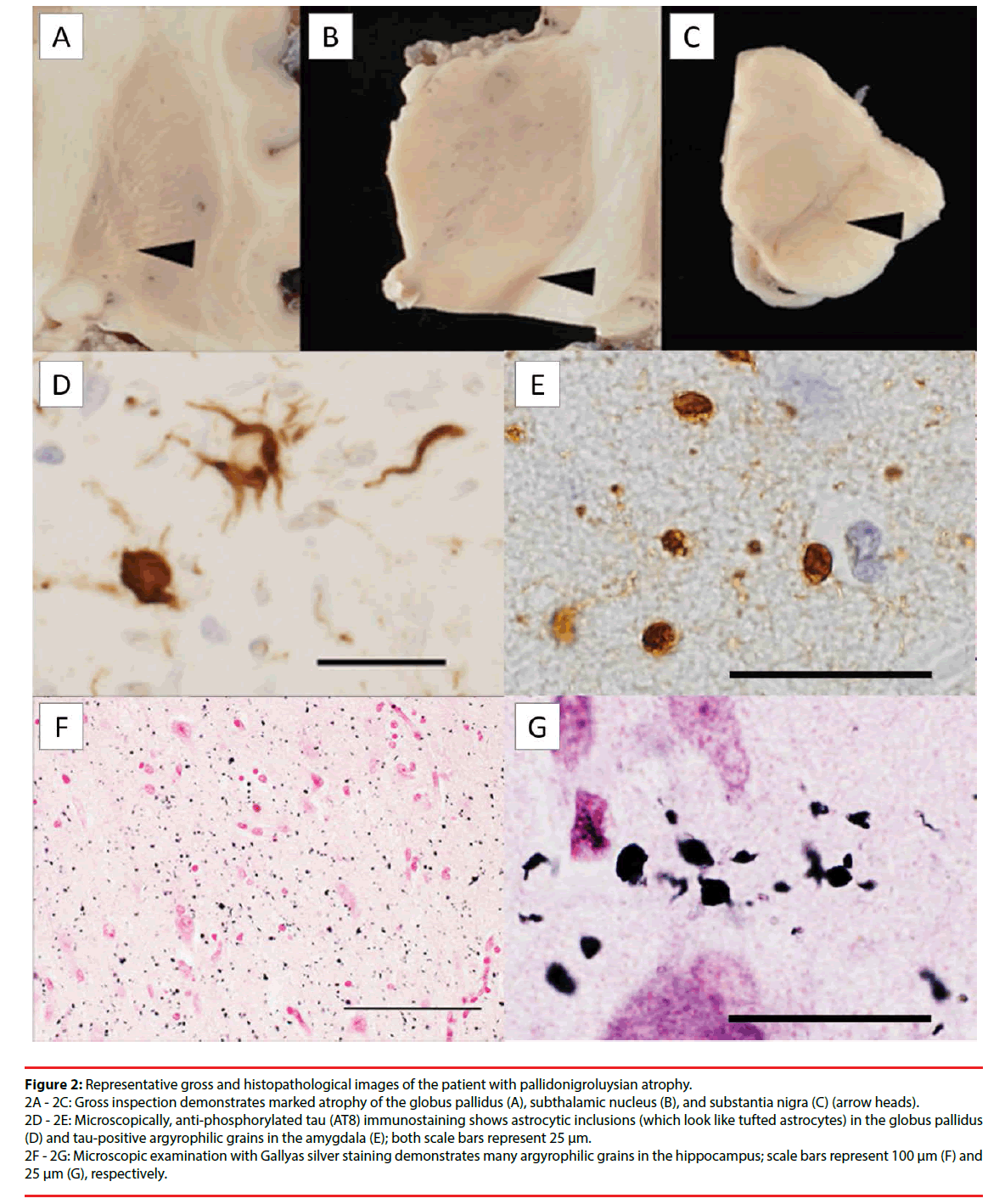 neuropsychiatry-argyrophilic-grains