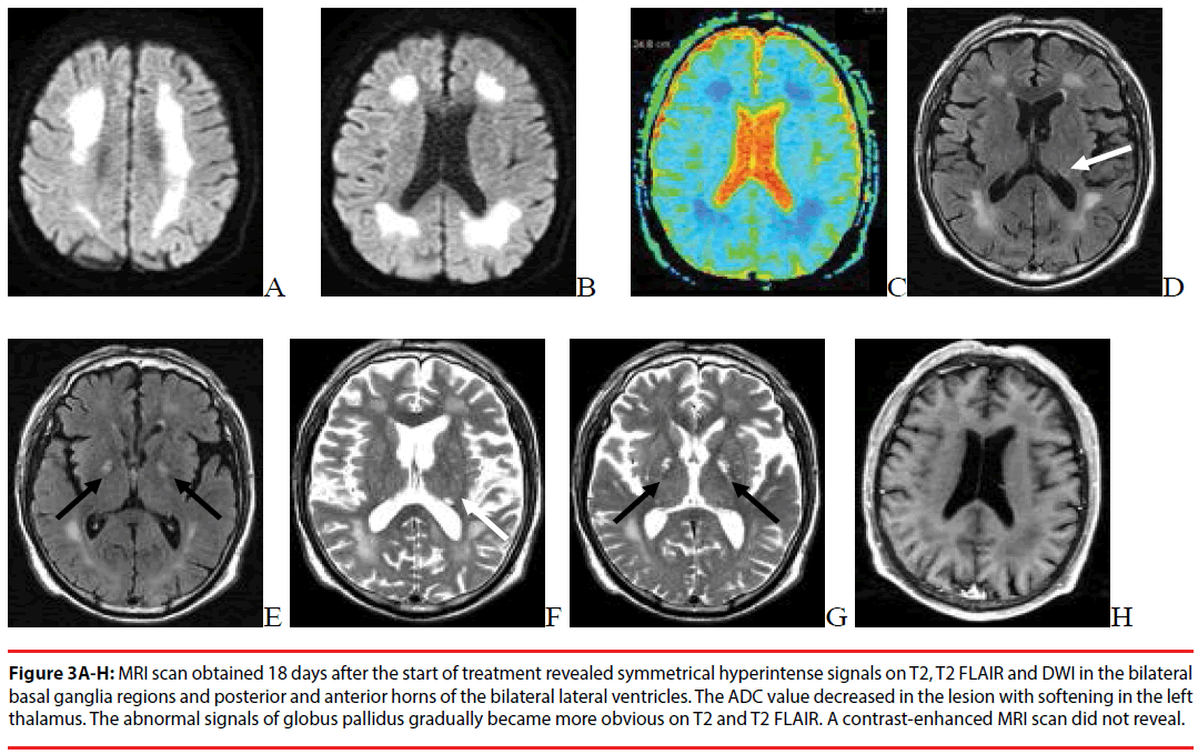 neuropsychiatry-basal-ganglia