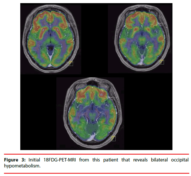 neuropsychiatry-bilateral-occipital