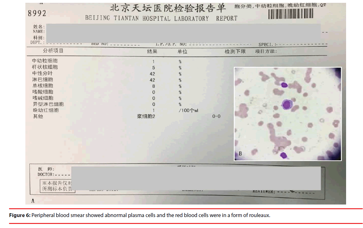 neuropsychiatry-blood-smear