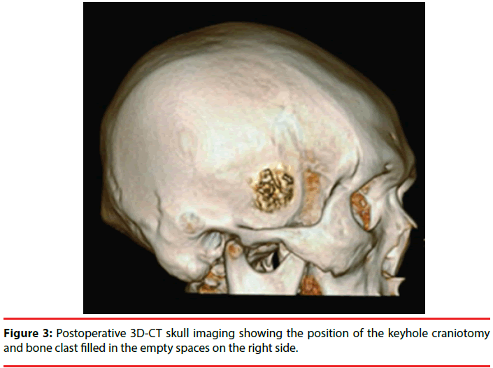 neuropsychiatry-bone-clast