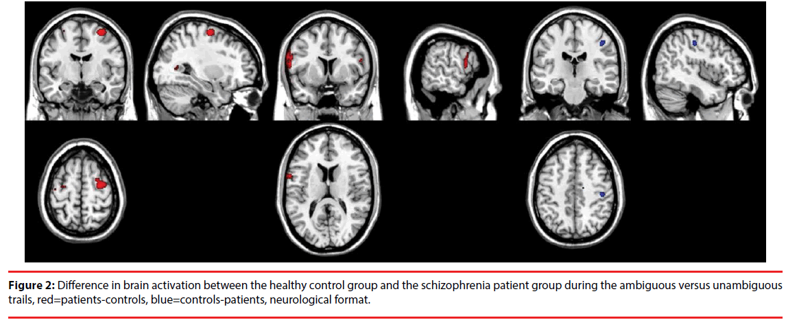 neuropsychiatry-brain-activation