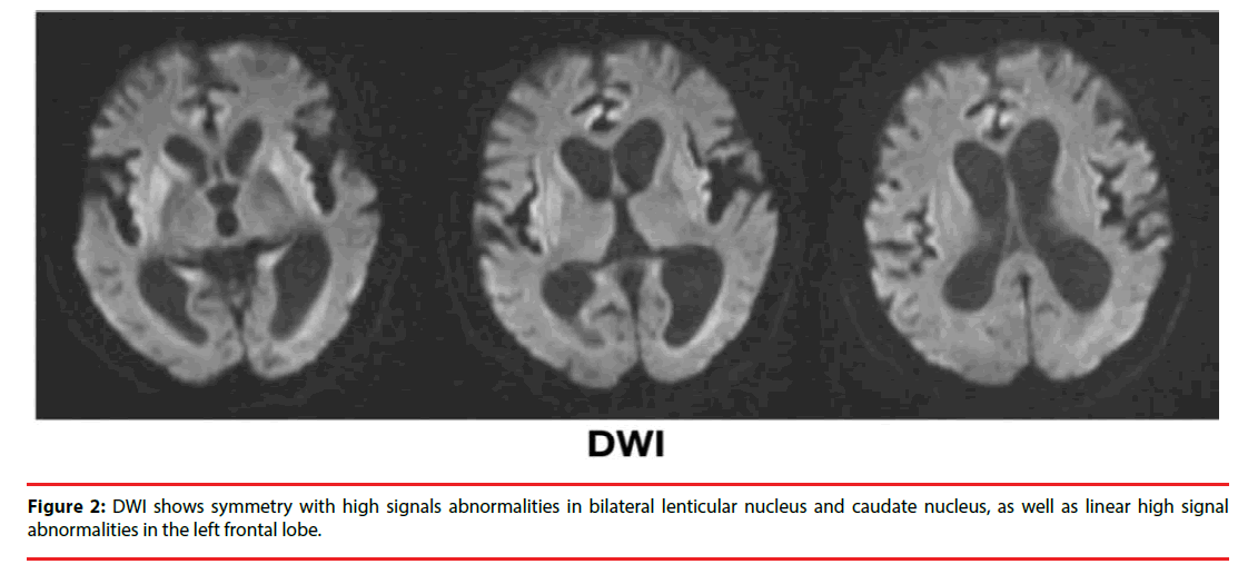 neuropsychiatry-caudate-nucleus