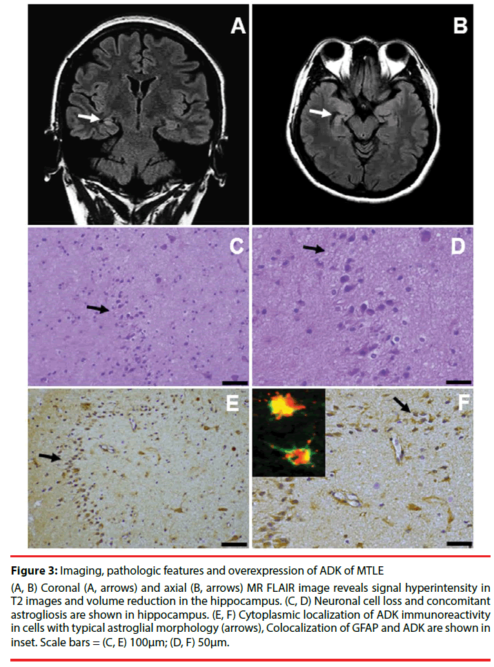 neuropsychiatry-cell-loss