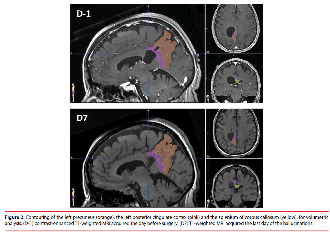 neuropsychiatry-cingulate-cortex