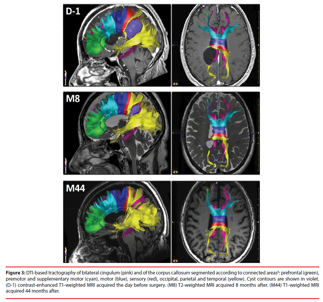 neuropsychiatry-corpus-callosum