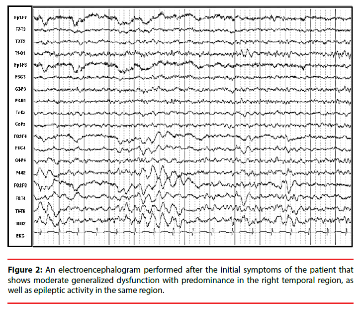 neuropsychiatry-electroencephalogram-symptoms