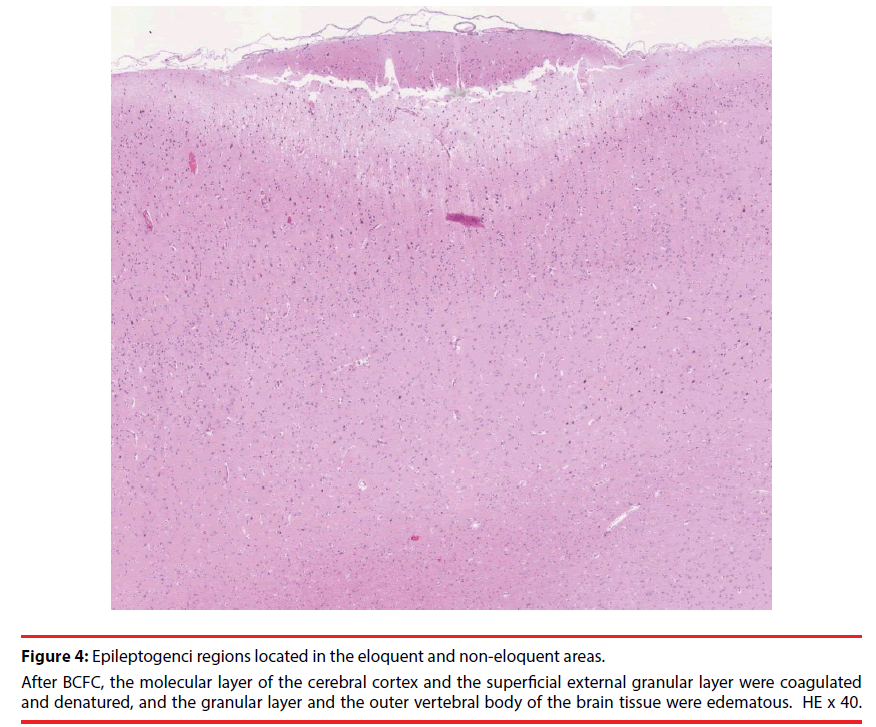 neuropsychiatry-eloquent-areas