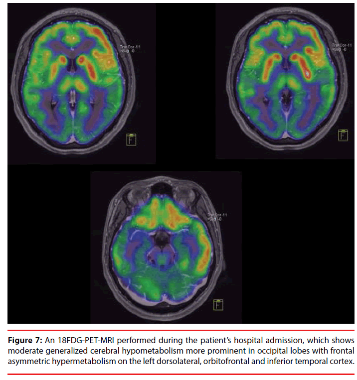 neuropsychiatry-hospital-admission