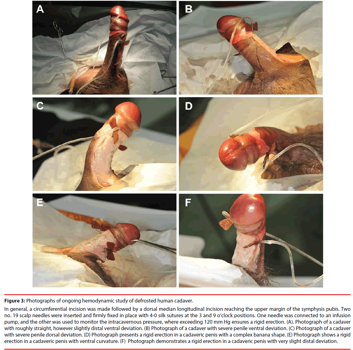 Saline Penis Injection