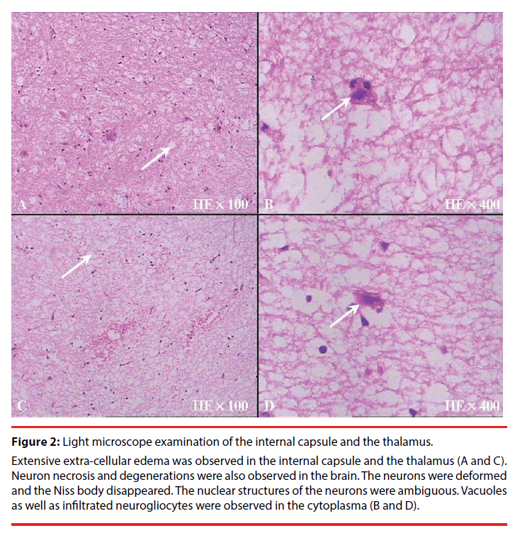 neuropsychiatry-internal-capsule
