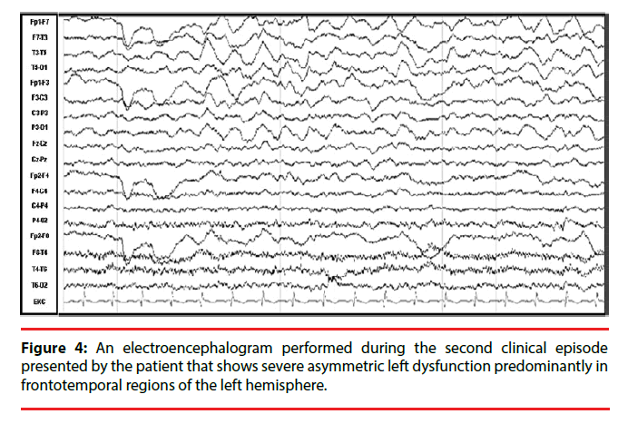 neuropsychiatry-left-hemisphere