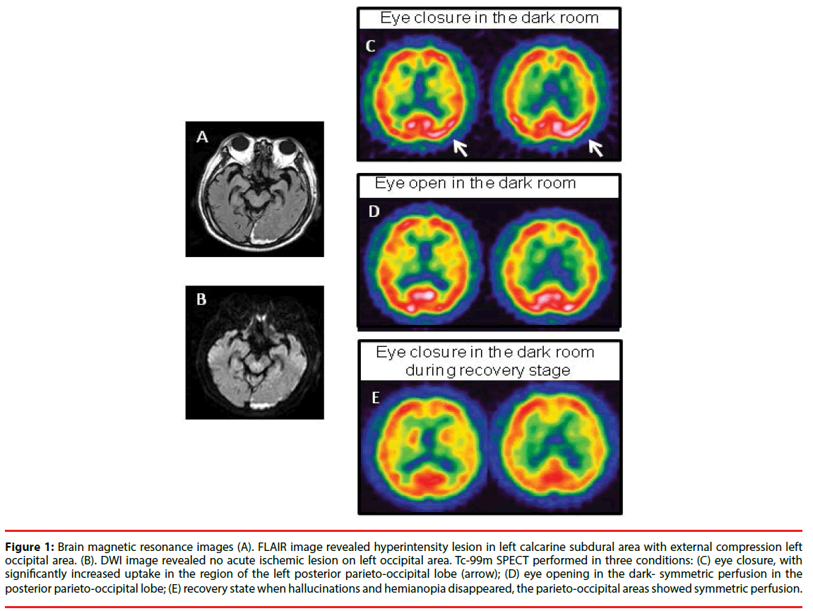 neuropsychiatry-lesion-left