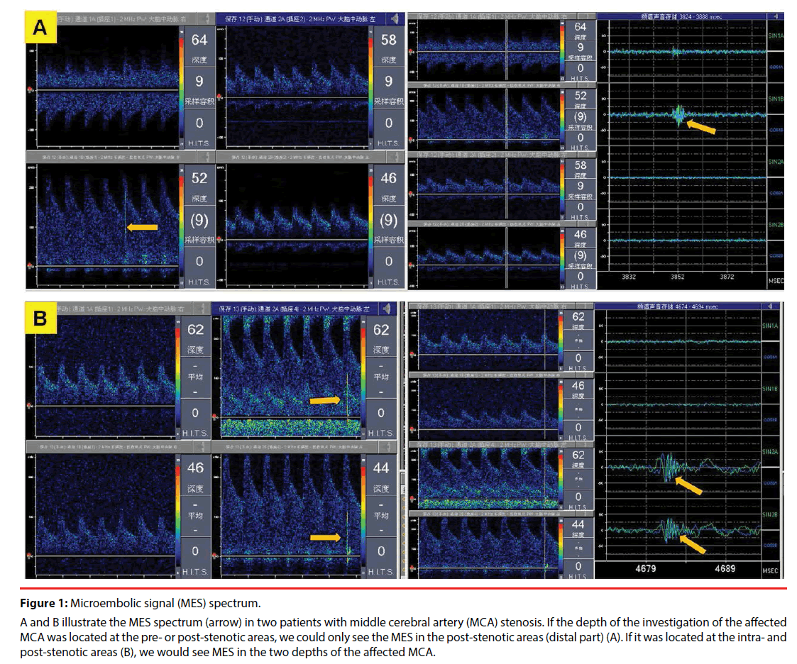 neuropsychiatry-microembolic-signal