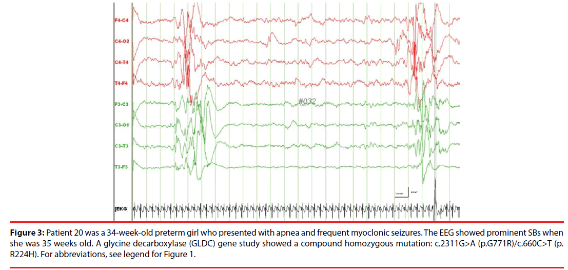 neuropsychiatry-myoclonic-seizures