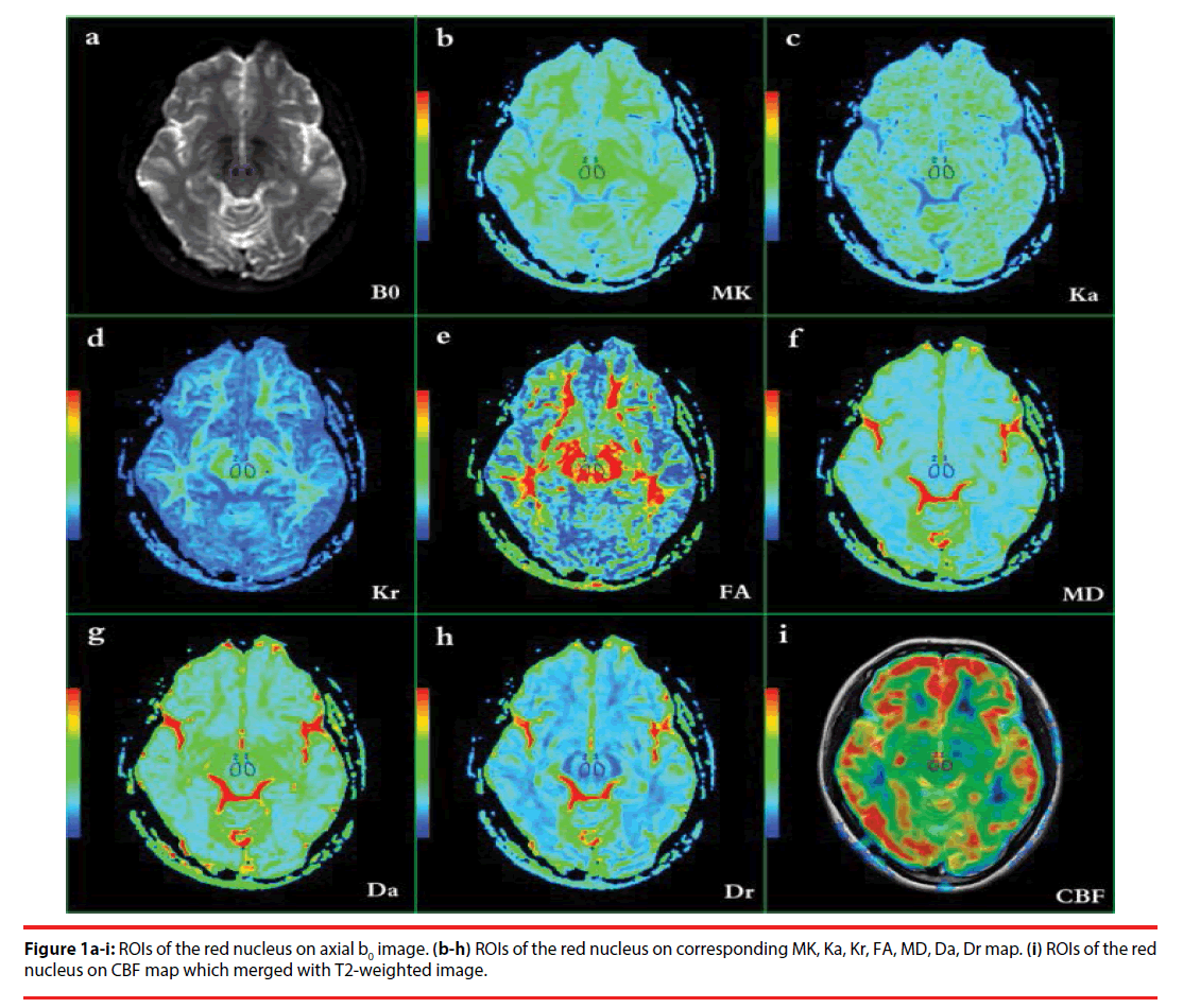 neuropsychiatry-red-nucleus