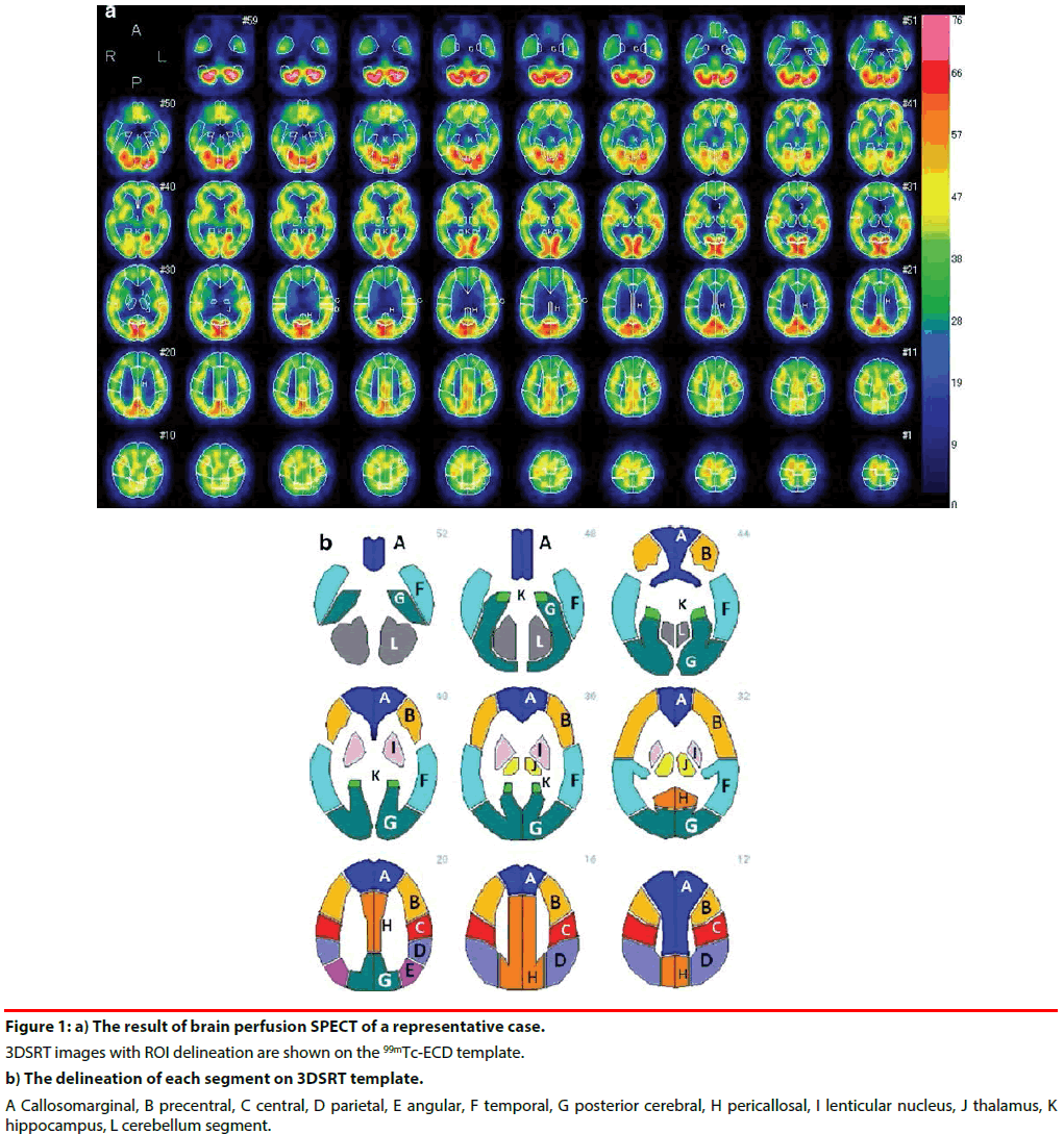 neuropsychiatry-result-brain-perfusion