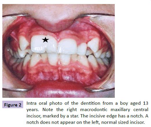 neuropsychiatry-right-macrodontic-maxillary