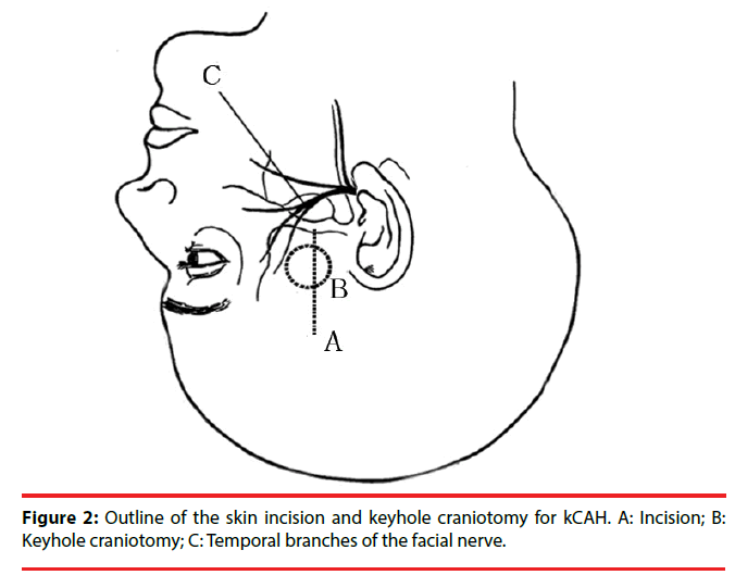 neuropsychiatry-skin-incision