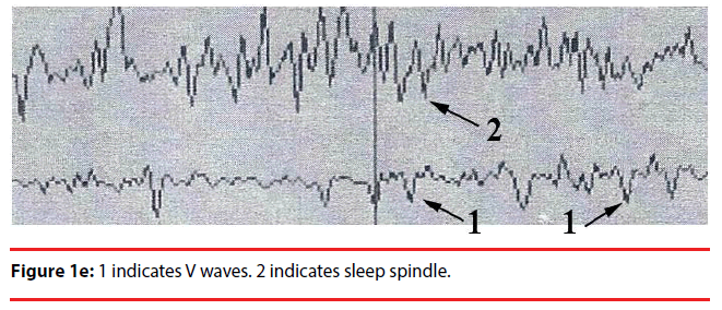 neuropsychiatry-sleep-spindle