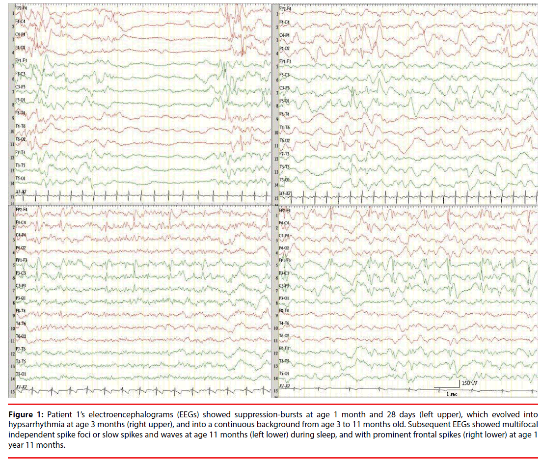 neuropsychiatry-spike-foci