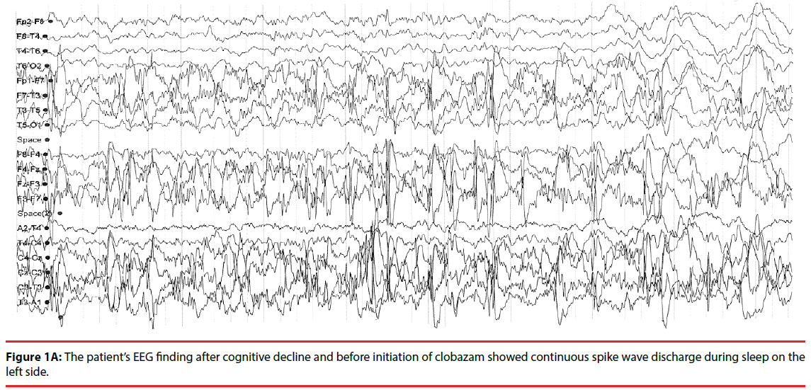 neuropsychiatry-spike-wave