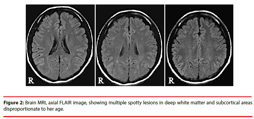 neuropsychiatry-spotty-lesions