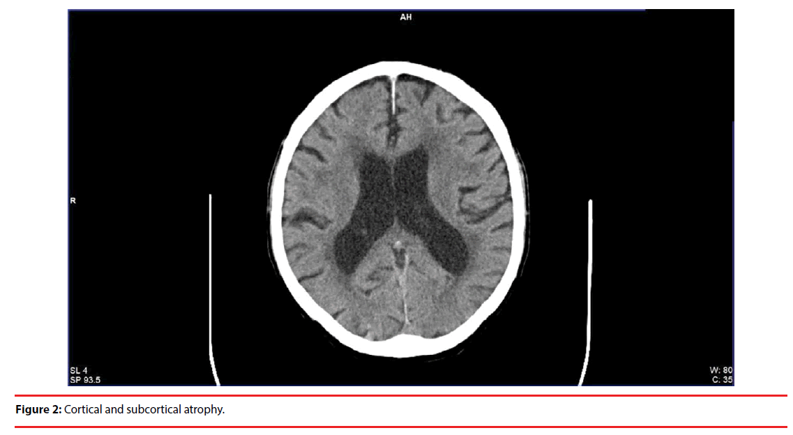 neuropsychiatry-subcortical-atrophy